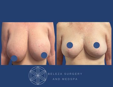 Patient 7 Breast Reduction Anterior.jpg