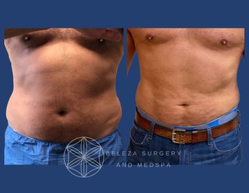 Patient 24 Lipo 360 Anterior (1).jpg