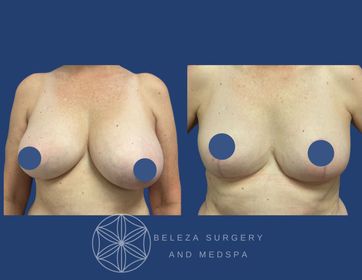 Patient 5 Breast Reduction Anterior.jpg