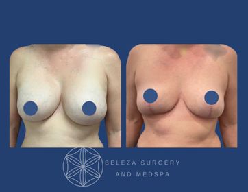 Patient 8 Explant Mastopexy.jpg