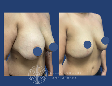 Patient 7 Explant Mastopexy Right.png