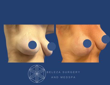 Mastopexy Augmentation Patient 9 Right Angle (1).jpg