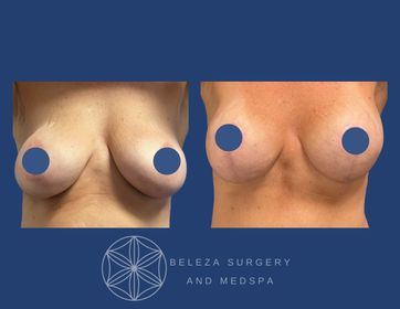Mastopexy Augmentation Patient 9 anterior (1).jpg
