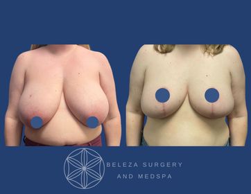 Patient 10 Breast Reduction Anterior.jpg