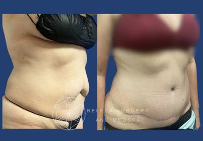 PATIENT 13 Abdominoplasty Right.jpg