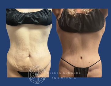 Patient 5 Panniculectomy Anterior.jpg