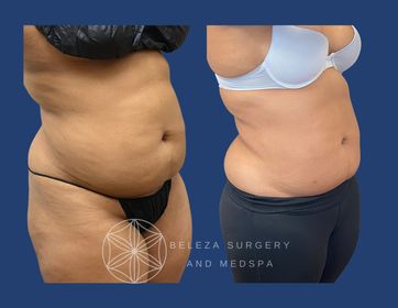 Patient 27 Liposuction Right angle (1).jpg