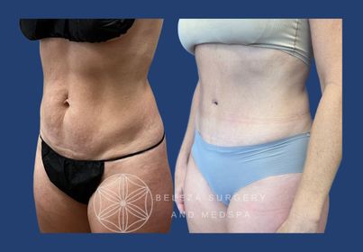 PATIENT 12 Abdominoplasty Left angle .jpg