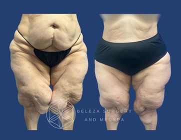 Patient 16 Lipo Inner Thighs (1).jpg