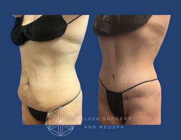 Patient 5 Left oblique.jpg
