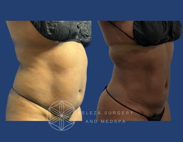 Patient 20 Lipo 360 and Bra Rolls Right Oblique (1).jpg