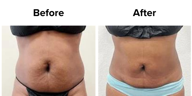 Liposuction (3).png