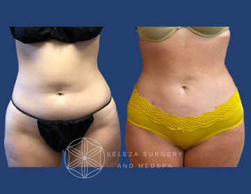 Patient 26 Lipo 3AA Anterior (1).jpg