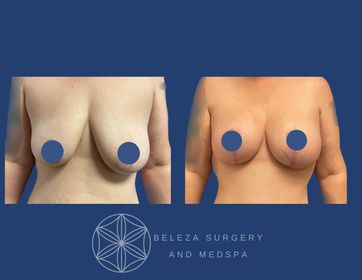 Mastopexy Augmentation Patient 8 anteriro (1).jpg
