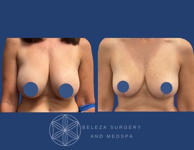 Patient 18 Breast Reduction Anterior.jpg