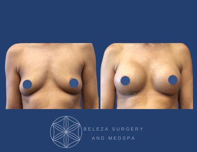 Patient 10 Breast Augmentation - Anterior.jpg