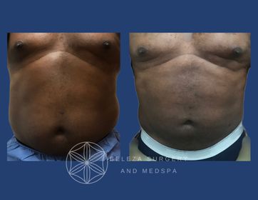 Patient 23 Lipo 3AA (1).jpg