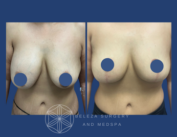 Patient 7 Explant Mastopexy.png
