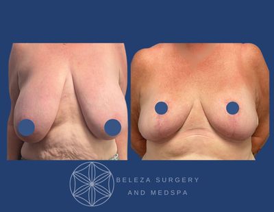 Patient 13 Breast Reduction Anterior.jpg