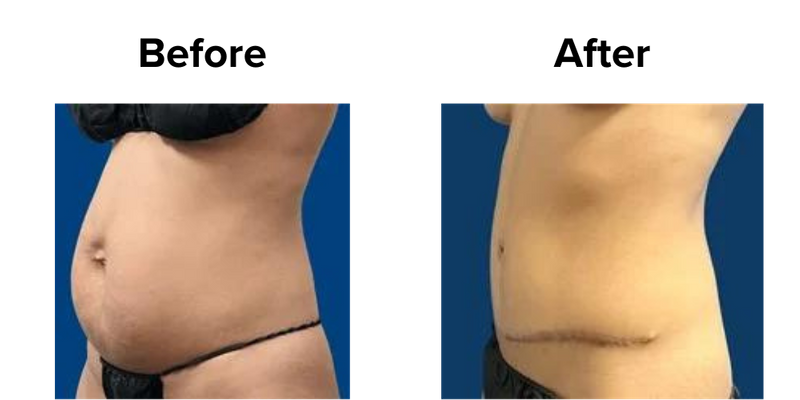 Tummy Tuck (1).png