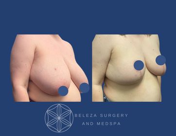Patient 10 Breast Reduction Right 45.jpg