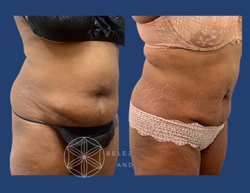 Patient 9 3AA Right oblique.jpg