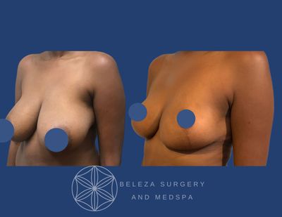 Patient 17 Breast Reduction Left angle.jpg