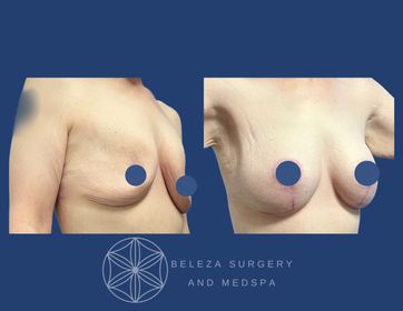Mastopexy Augmentation Patient 7 Right Angle (1).jpg