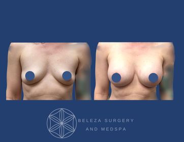 Patient 13 Breast Augmentation - Anterior (1).jpg