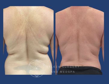 Patient 11 Lipo love handles, flanks, bra rolls Posterior (1).jpg