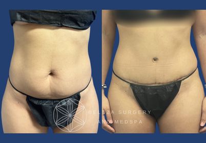Patient 18 Abdominoplasty (1).jpg