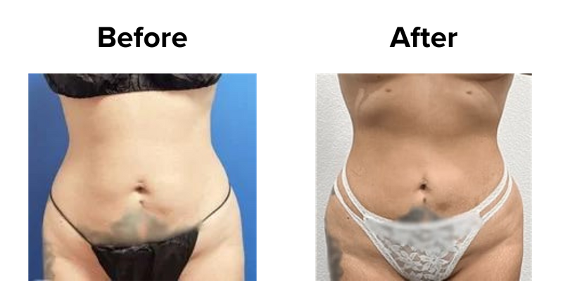 Liposuction (2).png