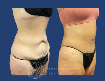 Patient 3 Panniculectomy Right angle.jpg
