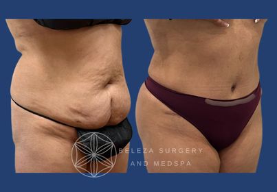 PATIENT 9 Abdominoplasty Right angle.jpg