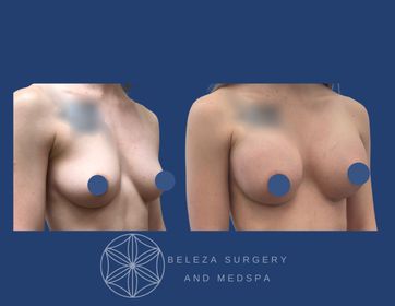 Patient 12 Breast Augmentation - Right Angle (1).jpg