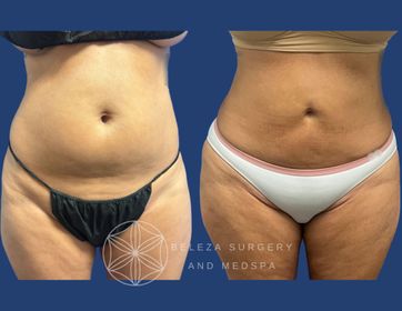 Patient 22 Lipo 3AA (1).jpg