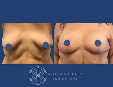 Mastopexy Augmentation Patient 2 Anterior (1).jpg