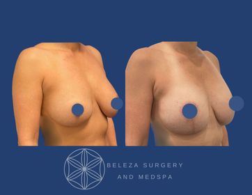 Patient 5 Mastopexy Right Angle.jpg