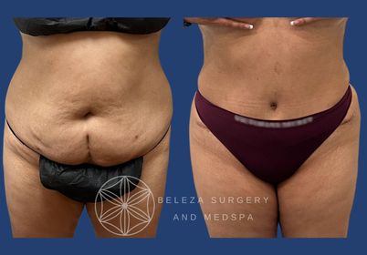 Patient 9 Abdominoplasty (2).jpg