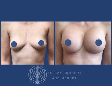 Patient 9 Breast Augmentation - Anterior.jpg