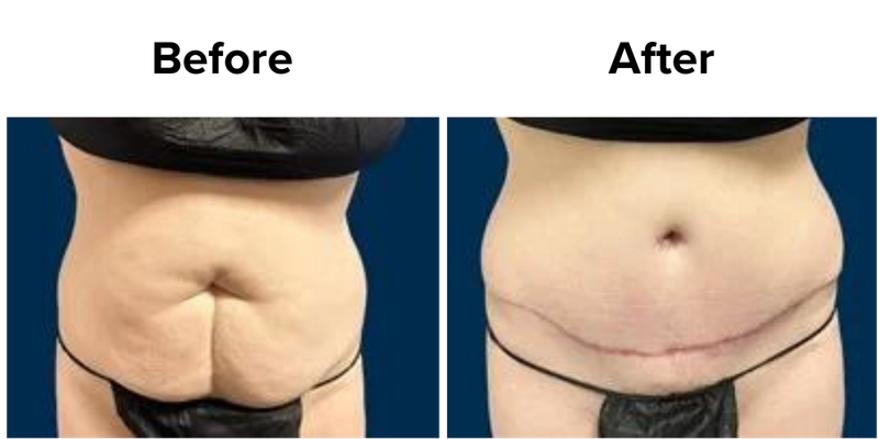 Body Contouring (2).png