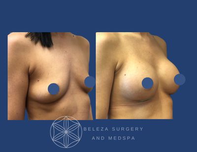 Patient 10 Breast Augmentation - Right Angle.jpg