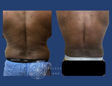 Patient 23 3AA Posterior.jpg