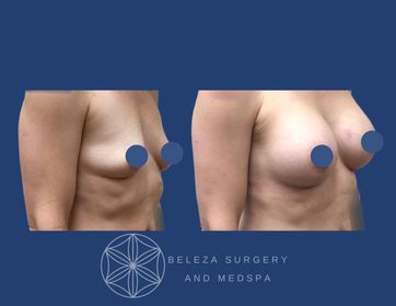 Patient 13 Breast Augmentation - Right Angle (1).jpg