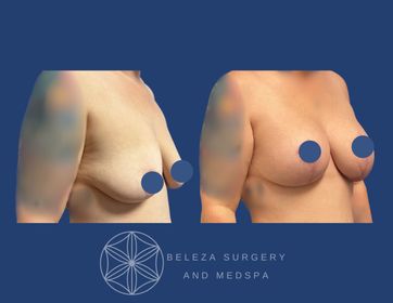 Mastopexy Augmentation Patient 8 Right Angle (1).jpg