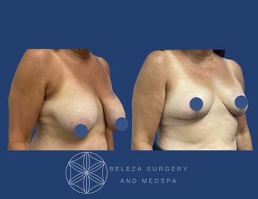 Patient 16 Breast Reduction Right 45 (1).jpg