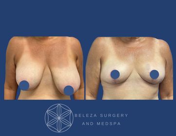 Patient 16 Breast Reduction Anterior (1).jpg