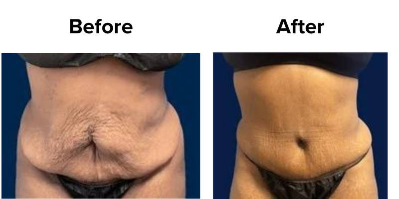 Tummy Tuck (3).png