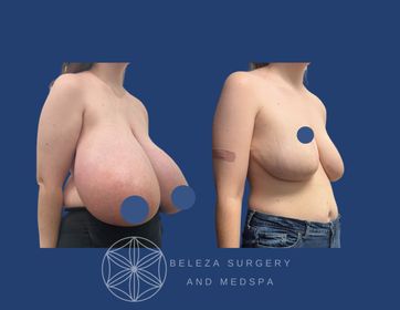 Patient 6 Breast Reduction Right 45.jpg