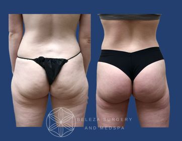 Patient 12 BBL Posterior (1).jpg